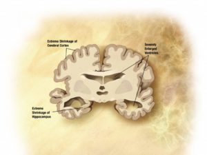 Keto for Alzheimer's